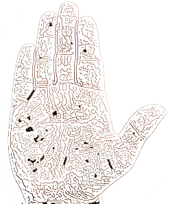 Thumb shorter than base of index finger